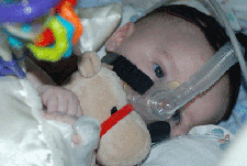 Infant with SMA Type I wearing BiPAP device